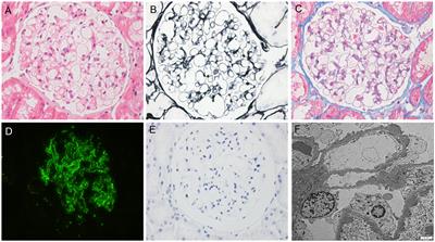 Case report: Successful treatment of refractory membranous nephropathy with telitacicept